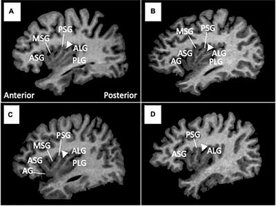 Gross anatomical features of the insular cortex in schizophrenia and schizotypal personality disorder: Potential relationships with vulnerability, illness stages, and clinical subtypes